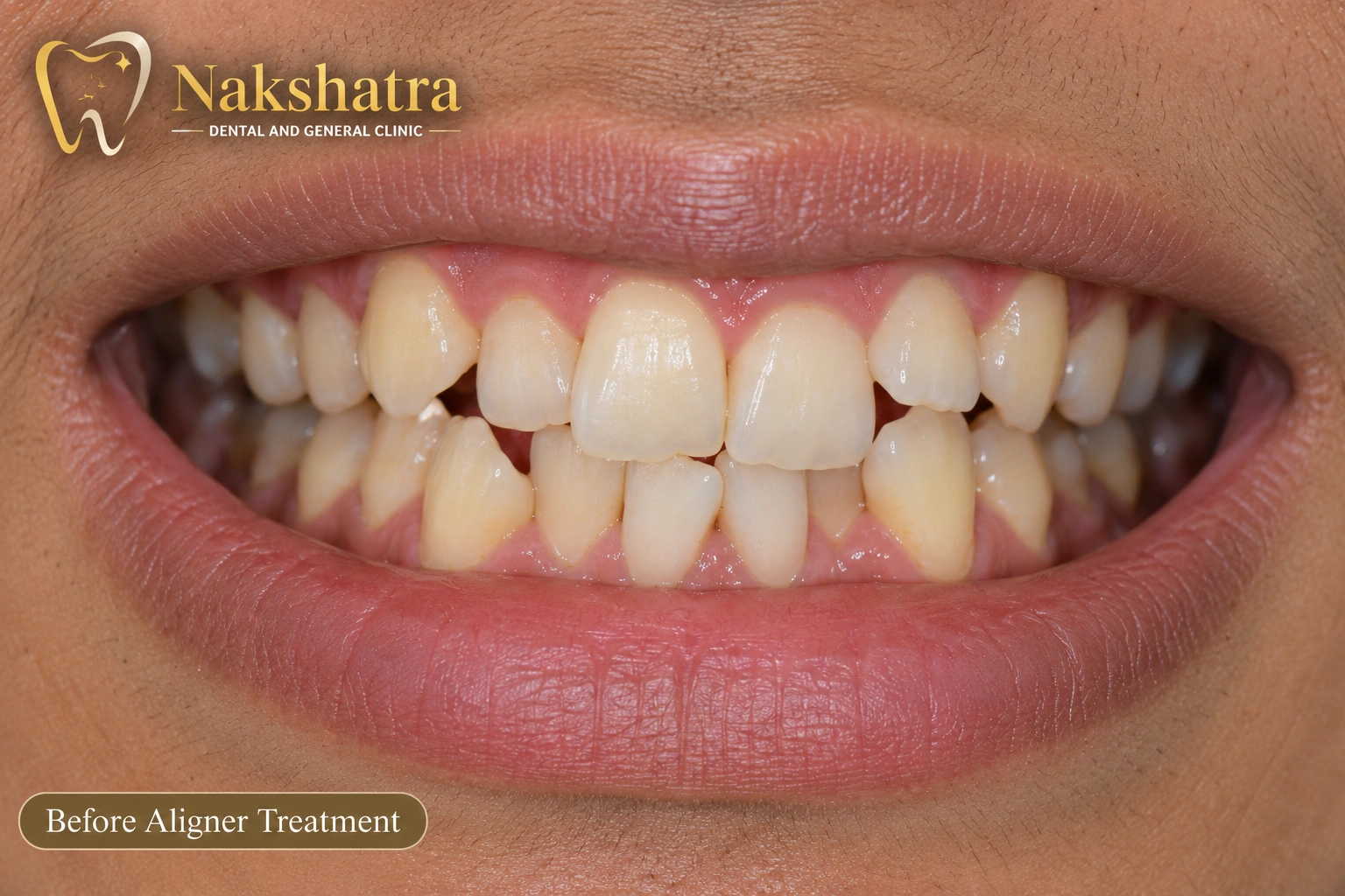 Before dental smile transformation, case 1